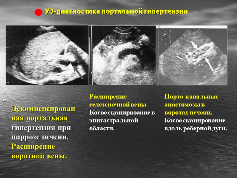 УЗ-диагностика портальной гипертензии . Декомпенсированная портальная гипертензия при циррозе печени. Расширение воротной вены. 